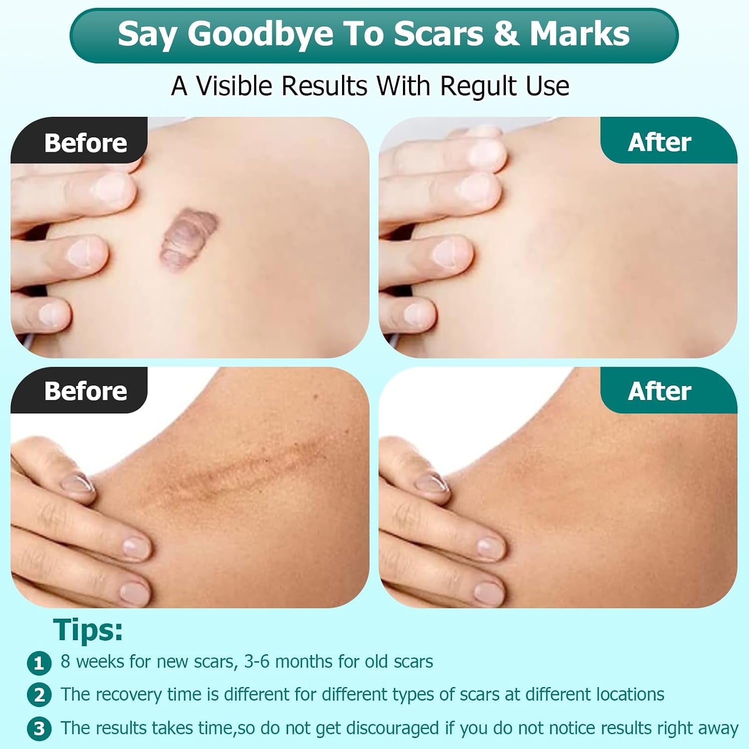 Scar Gel, Scar Cream, Advance Scar Gel for Surgical Scars,Face,Body,Leg, Burns, Acene,C-Section, Stretch Marks, Keloids for Old & New Scars,Scar Removal for Women Men,1.76Oz